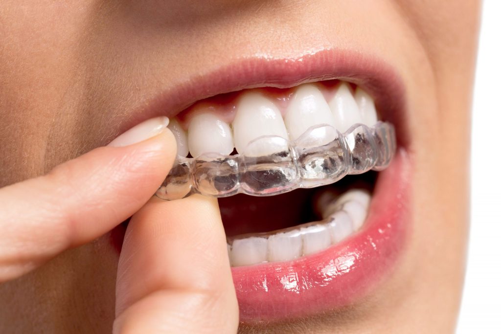 Lucariello Odontoiatria - Invisalign