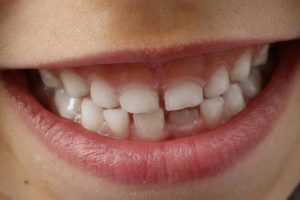 Lucariello Odontoiatria - Ipomineralizzazione denti bambini